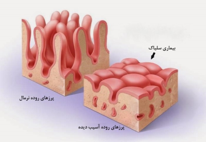 سلیاک